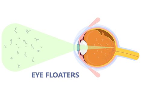 Eye Floaters Overview: Explore Basics, Causes, Facts, and Helpful Information