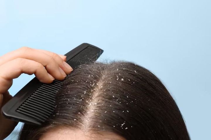 Ketomoon Shampoo and Other Effective Anti Dandruff Shampoo Options for Scalp Care